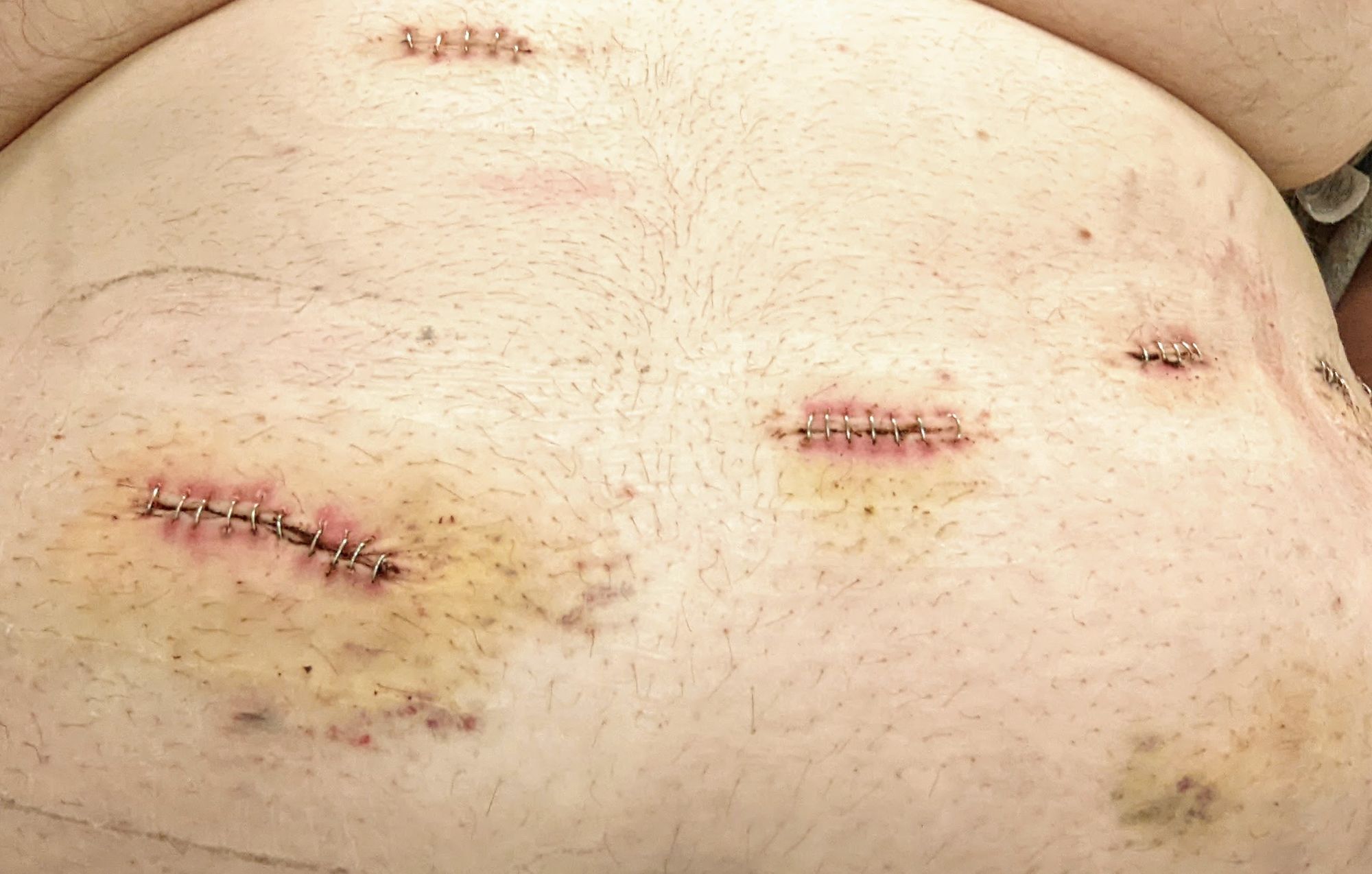 One month post-surgery blues